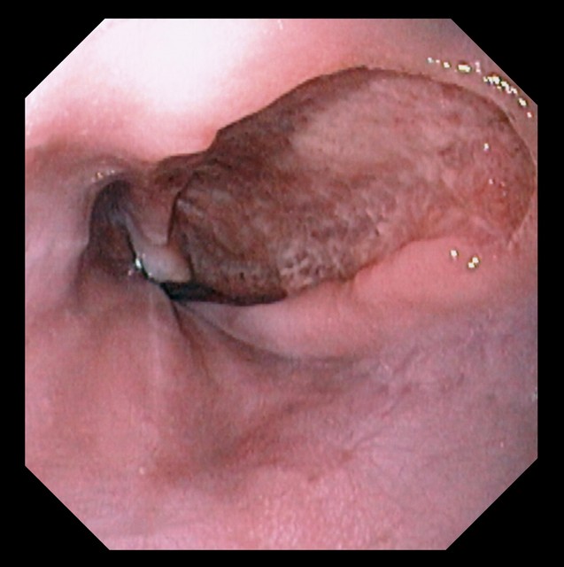 治胃溃疡奥美拉唑,胃溃疡特效药奥美拉唑价格