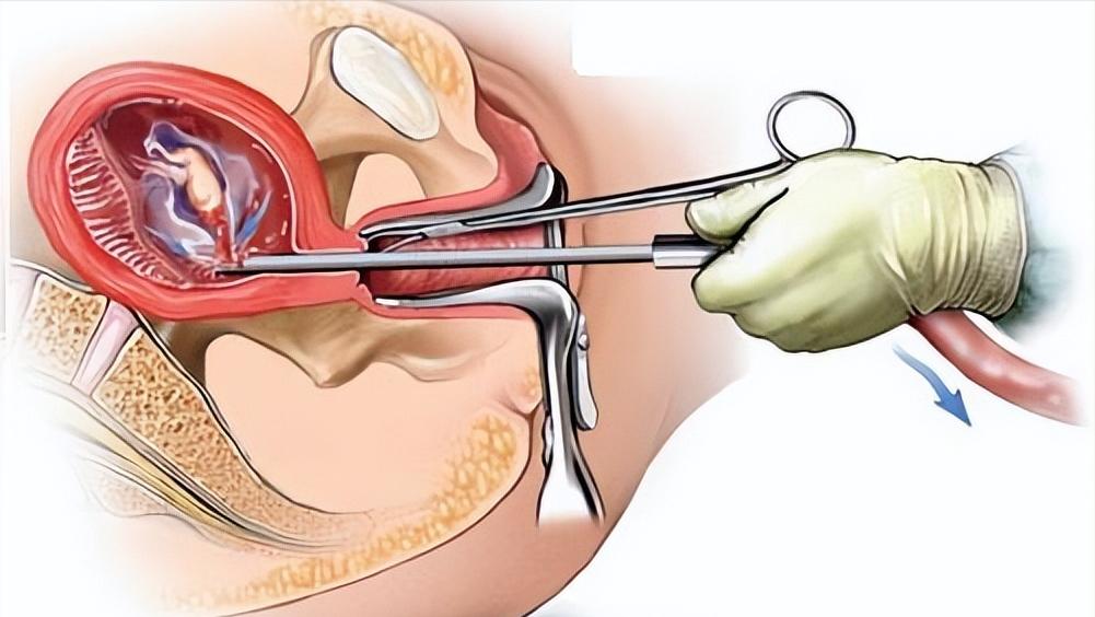 试纸、抽血均显示怀孕，为什么医生却说没怀孕？怀孕还能有假的？