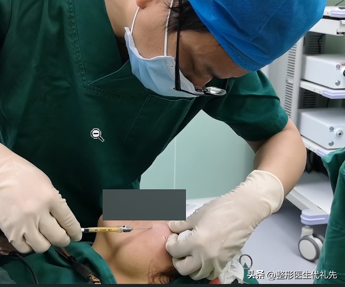 脂肪填充苹果肌刚填充的效果,填充苹果肌用什么填充