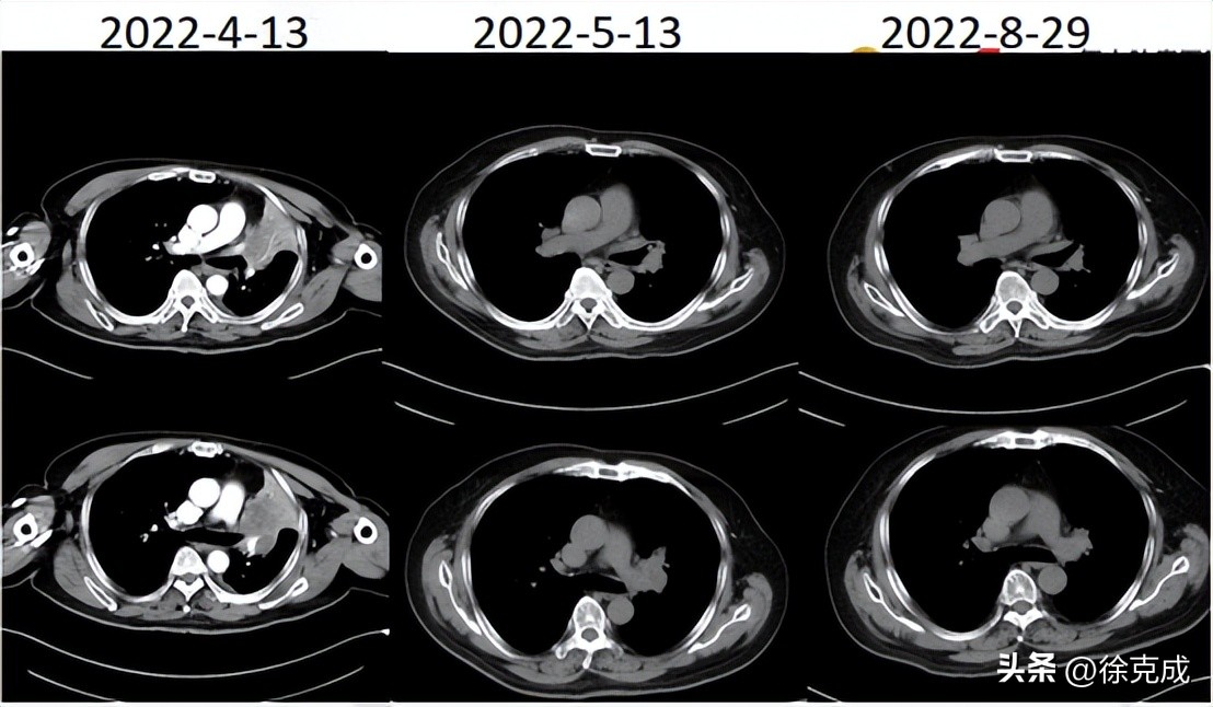肺癌电场疗法,肺癌吸入疗法