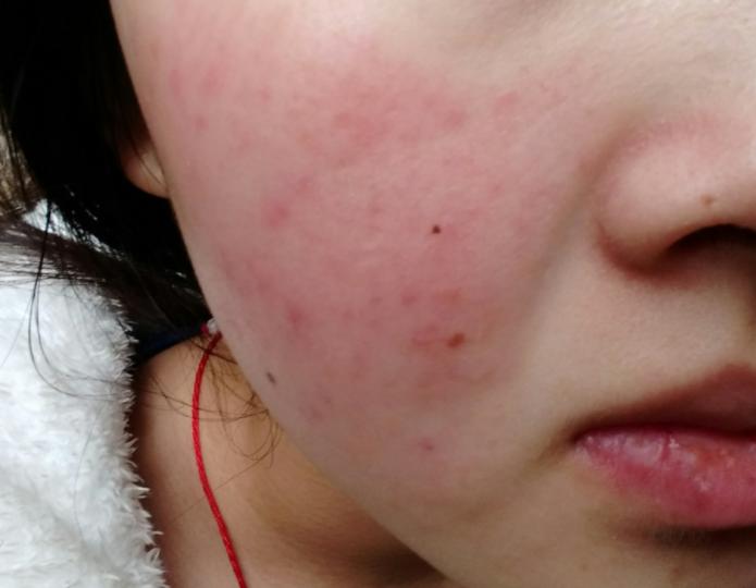 用护肤品感觉刺痛是缺水吗,护肤时刺痛是皮肤缺水吗