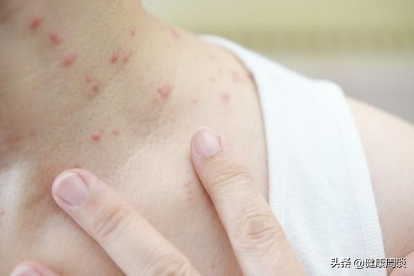 *麻疹荨**是怎么产生的？医生：多半与4个因素有关，别傻傻往上撞