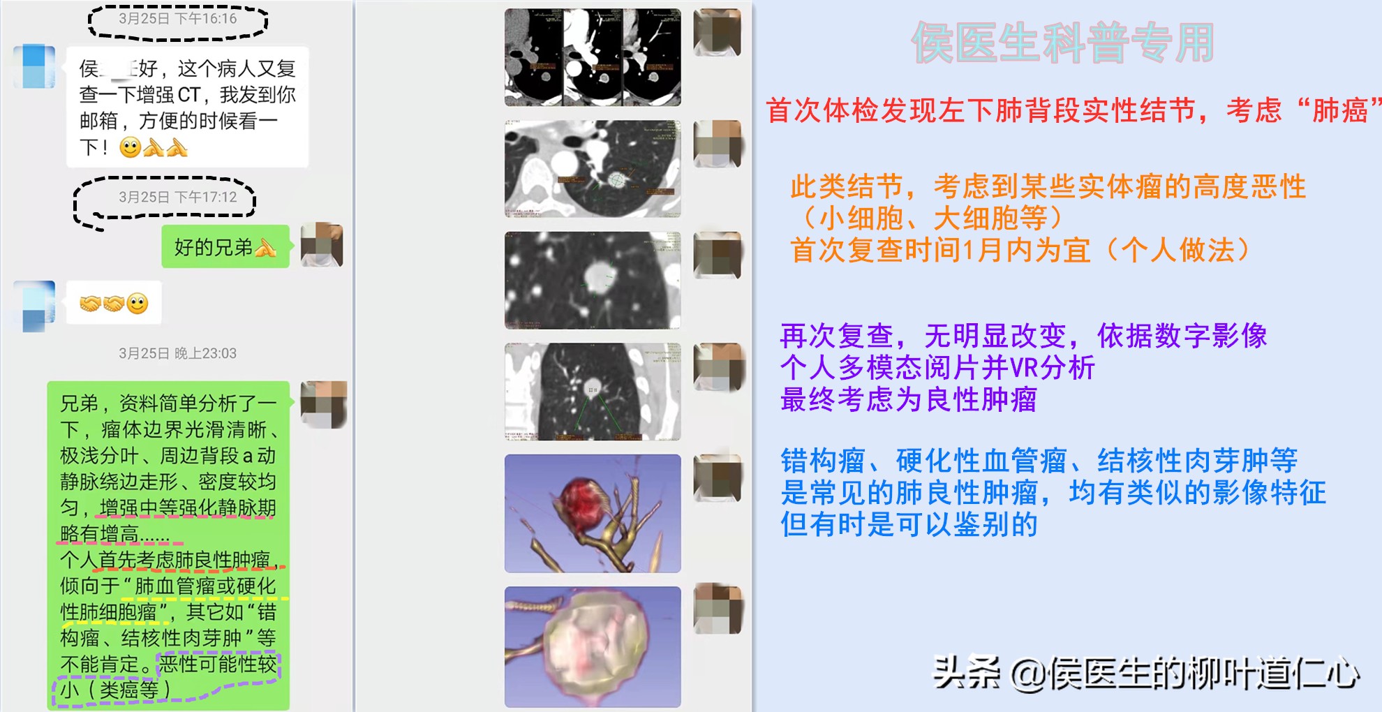 这例“被肺癌”的结节，手术不过度，但完全可以延迟在疫情后