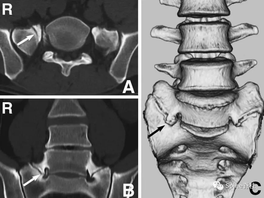 腰椎间盘突出下肢放射痛严重吗,下肢放射疼痛是间断性严重吗