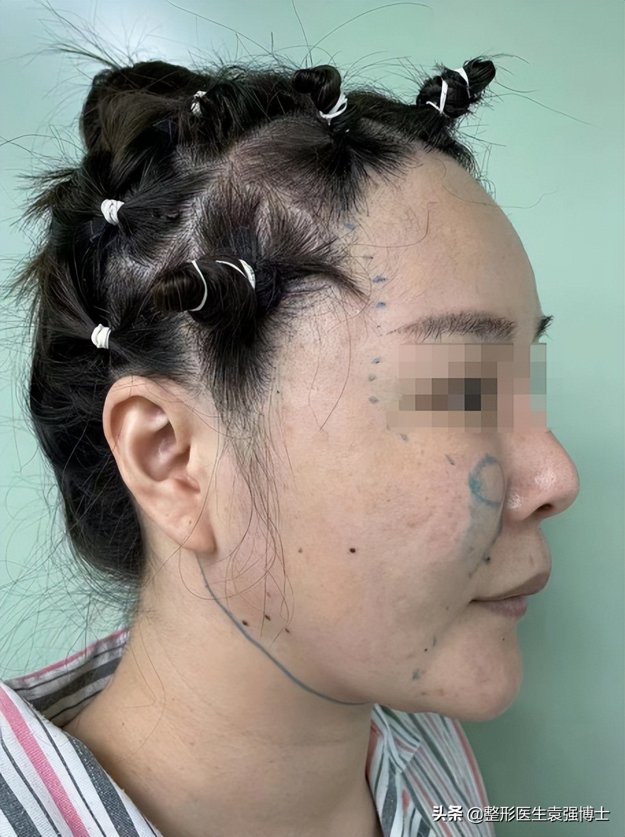 女子整容上瘾取出800颗假体,女子疯狂整容100次成芭比疯狂丰唇