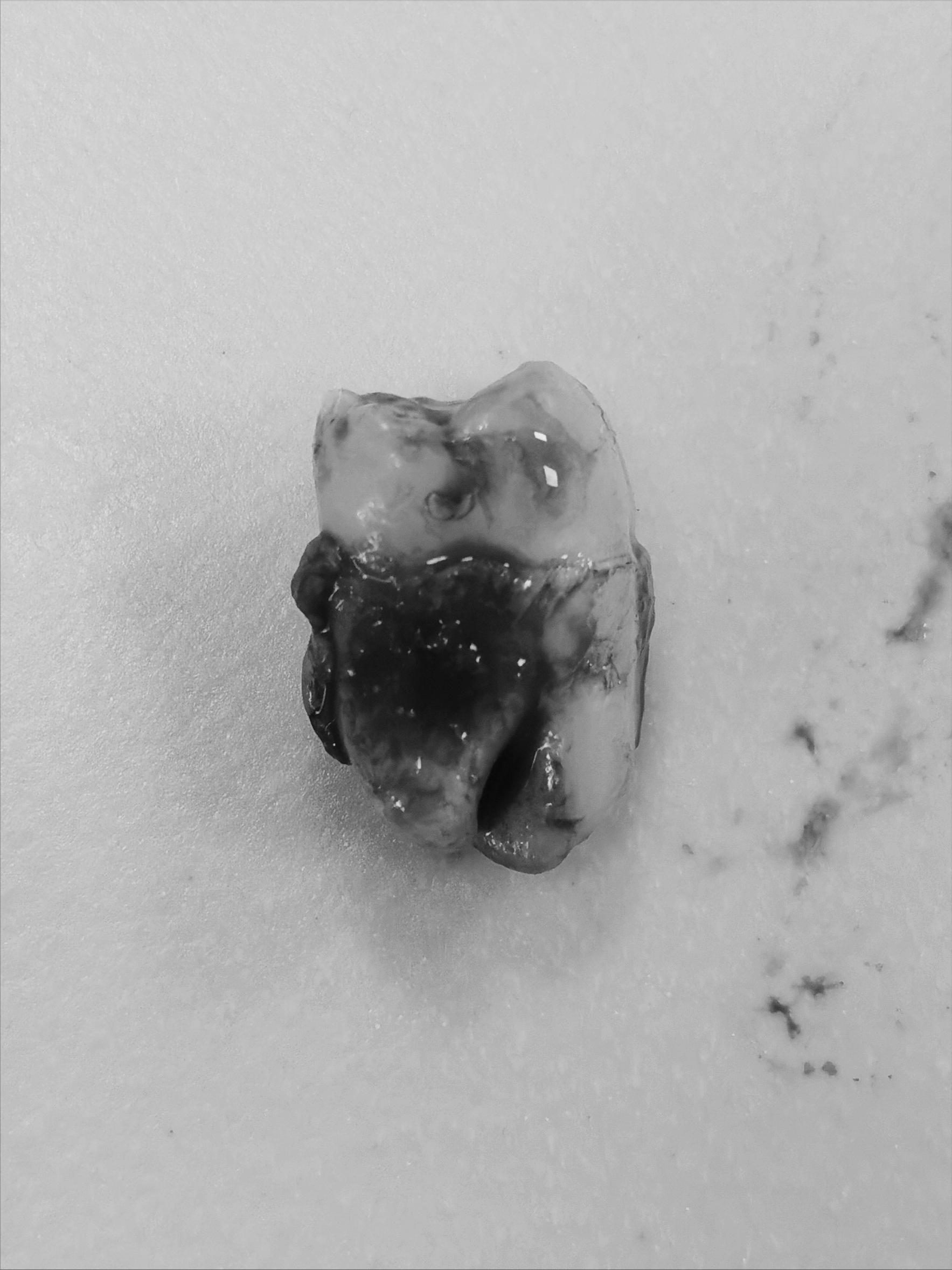 左下智齿拔除视频怎么正确拔除,复杂智齿拔除操作详细流程