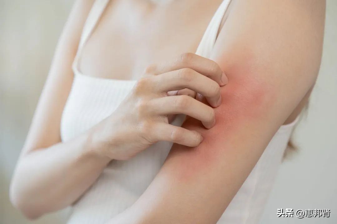 透析病人皮肤瘙痒是否可以多洗澡,透析皮肤痒止痒的办法