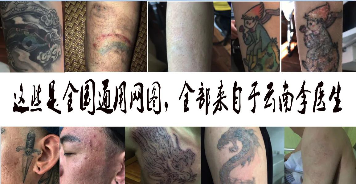 为洗纹身买单,洗纹身有什么代价