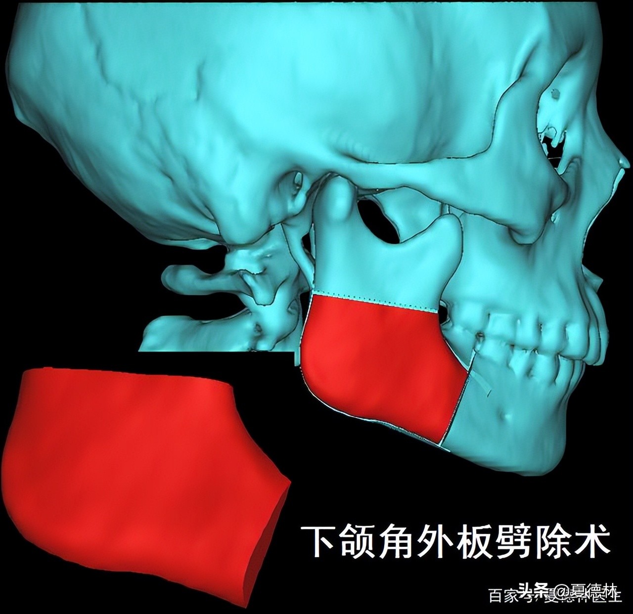 下颌角手术怎么避免后遗症,下颌角手术前要准备什么