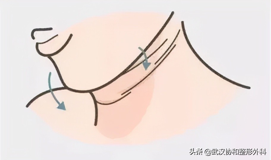 有颈纹怎么去除颈纹,颈纹去除最有效产品