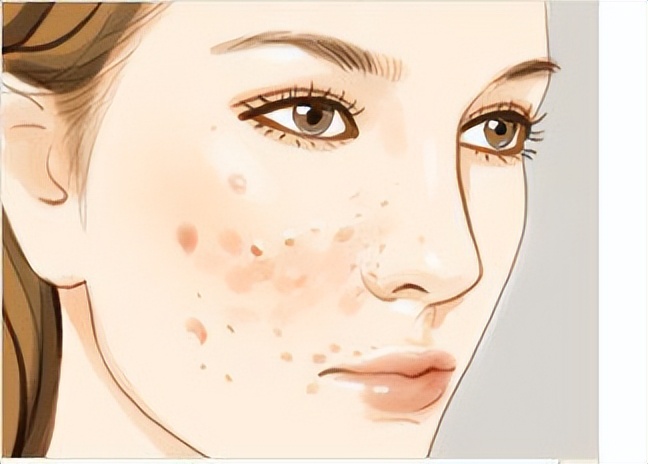 湿热型痤疮最有效的方子,中医治疗脸上痤疮痘痘的方剂