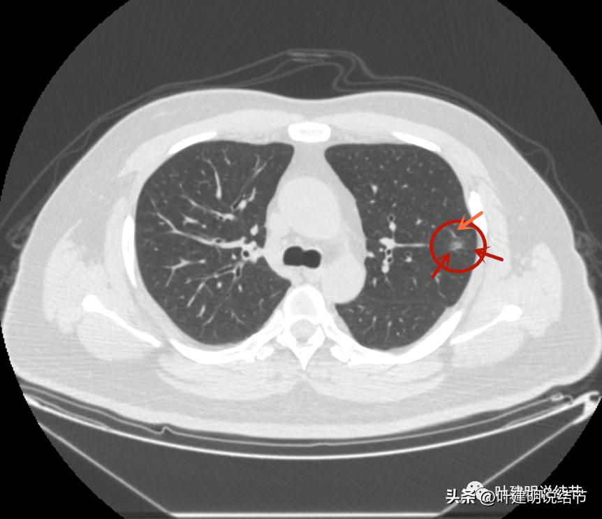 如何判断肺磨玻璃结节是高危结节,肺上有混合磨玻璃结节要注意什么
