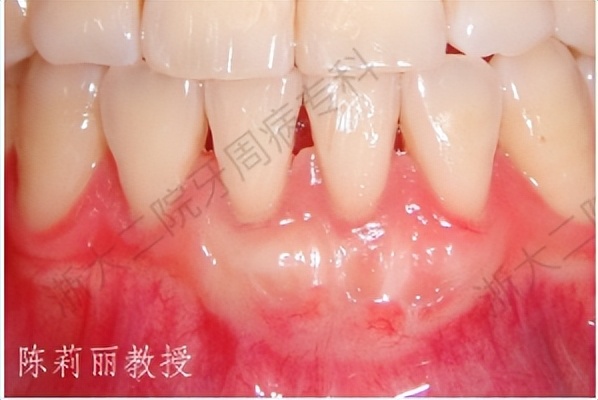 怎么拯救脱发小仙女,如何拯救牙齿上的黑洞