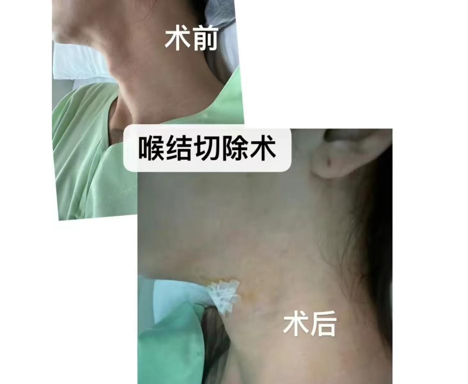 泰国做变性手术新闻,泰国变性手术网红男