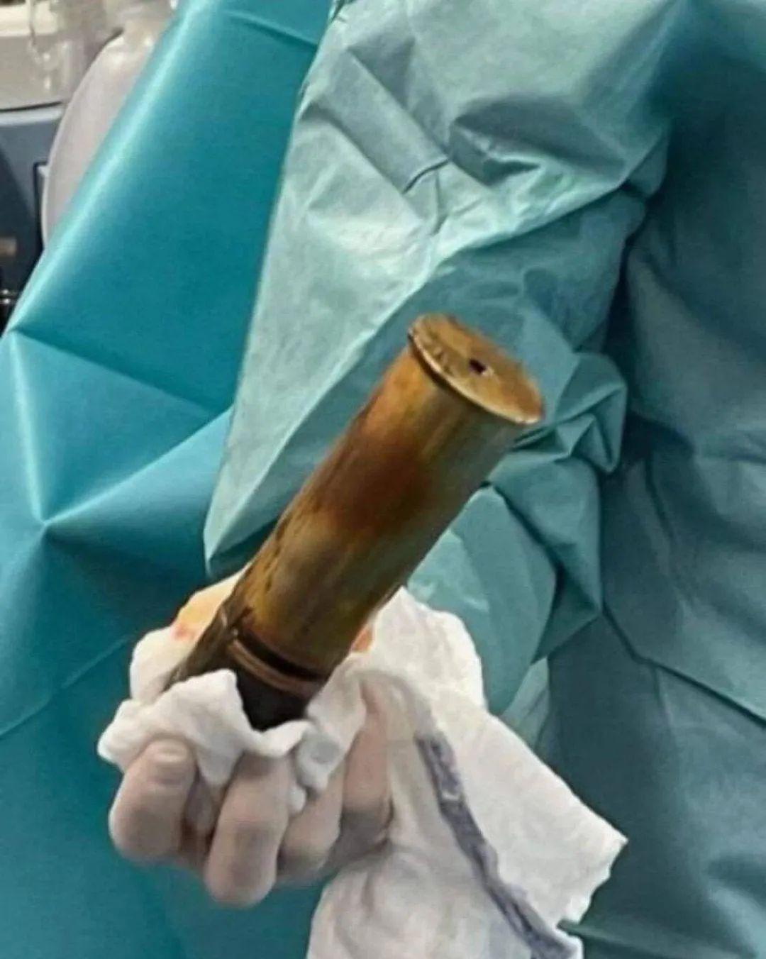 15个荒诞实事：印度征收“乳房税”，阴道里长了“一颗牙”