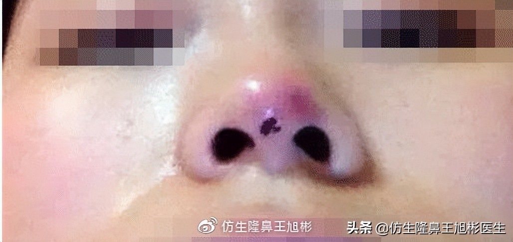 假体隆鼻的危害和后遗症,隆鼻整形麻醉你能坚持多长时间