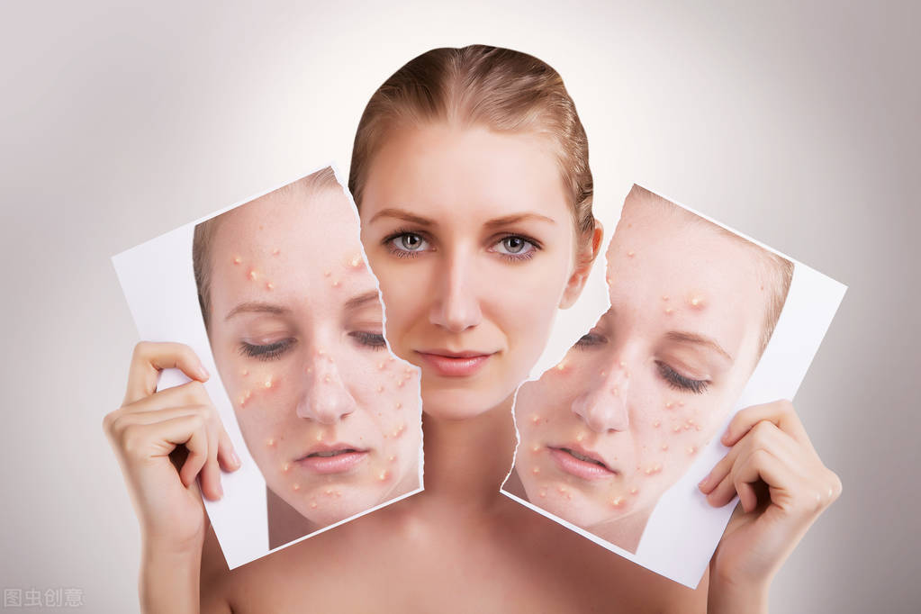 容易长痘痘用什么护肤品,夏天容易长痘祛痘良方