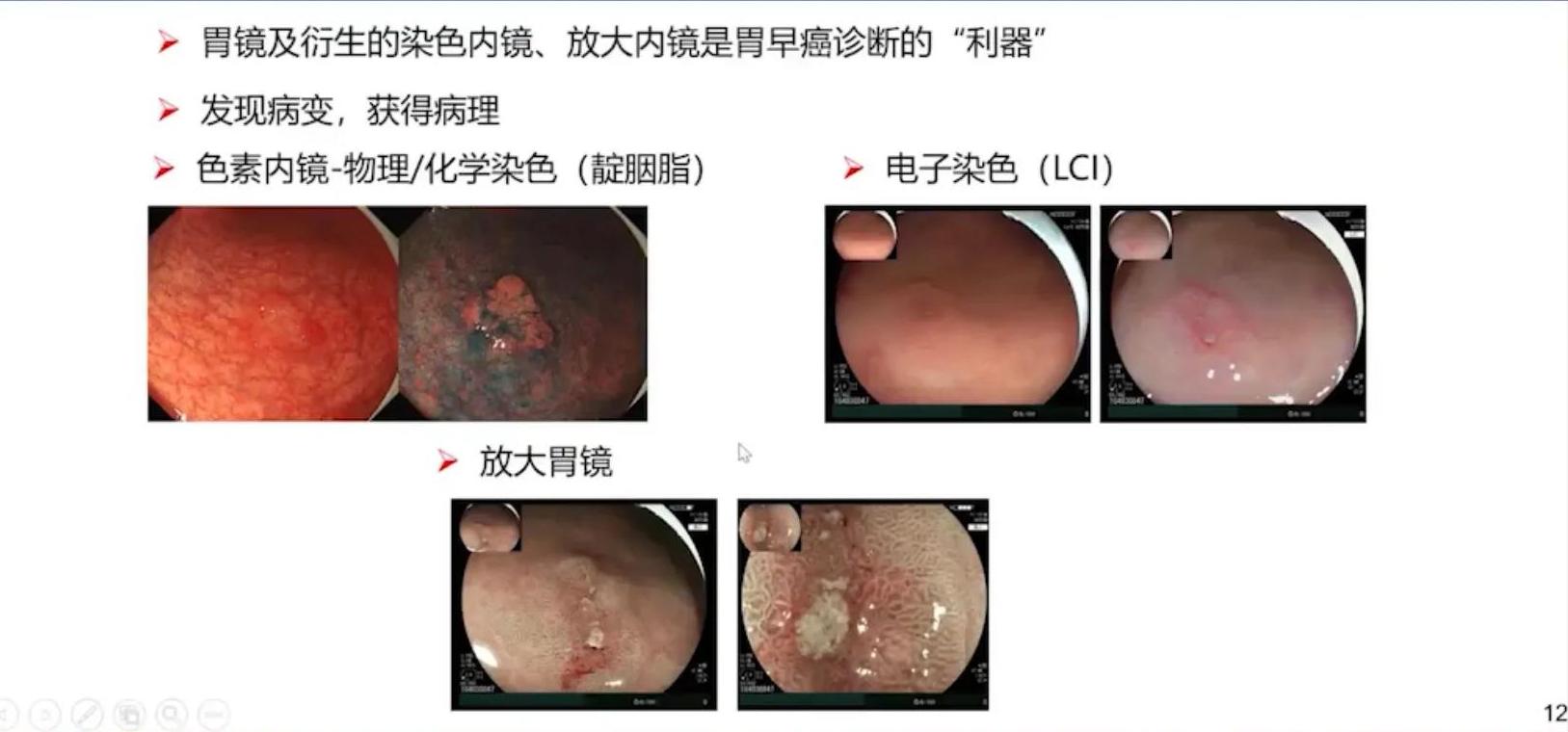 胃早癌食管早癌会复发吗,胃早癌与进展期癌怎么区分