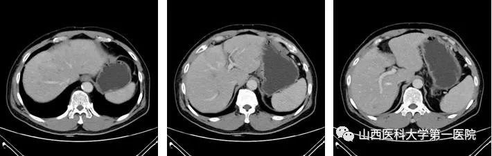 山西医科大学第一医院多学科凝心聚力攻克癌中之王再创新高