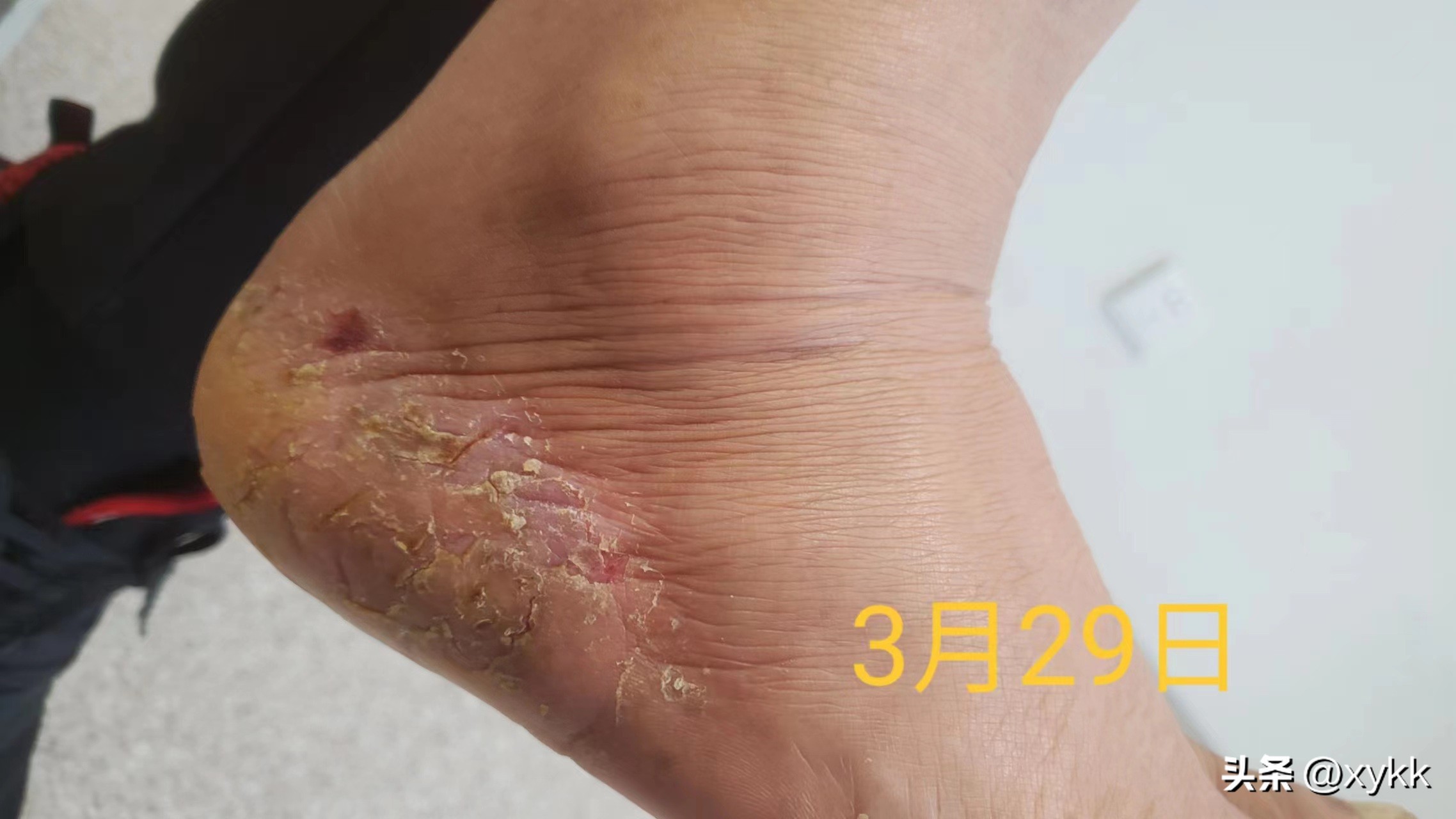 治疗脚部和手部湿疹,调理脾胃治疗湿疹