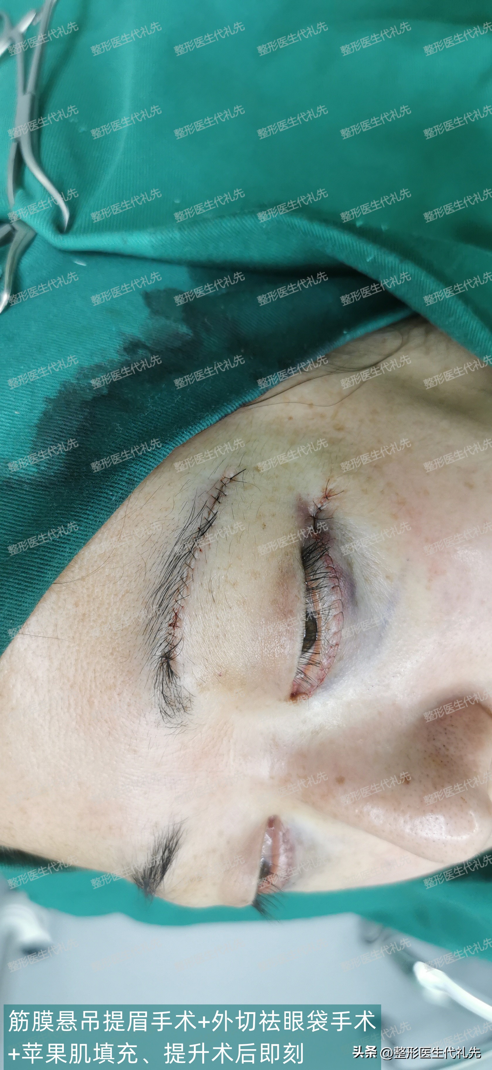 眼袋的原因及消除方法,眼袋是什么原因怎么去除