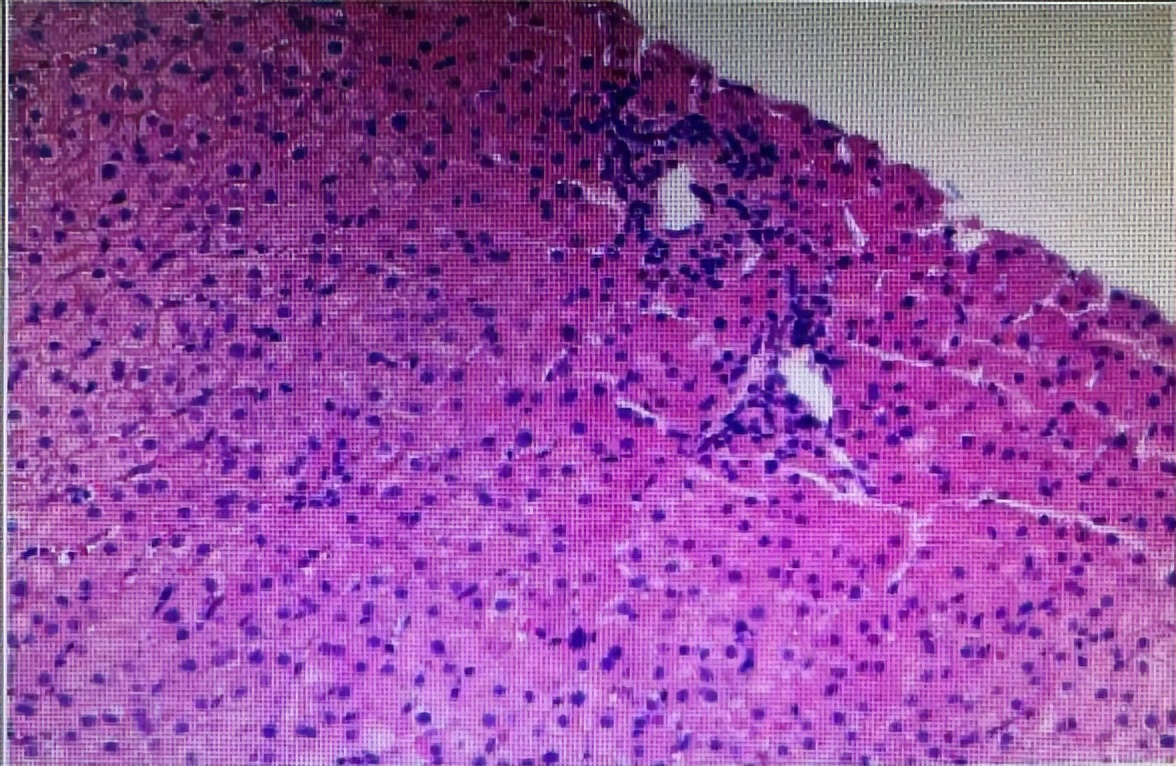 黄疸遗传代谢性疾病,遗传代谢性黄疸怎么治疗
