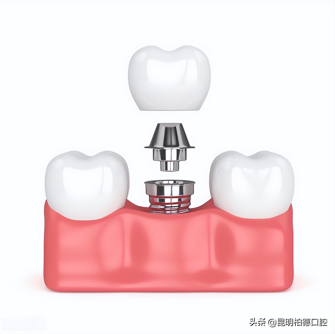 牙齿什么问题都没有用什么牙膏,牙齿什么事都没就要做根管