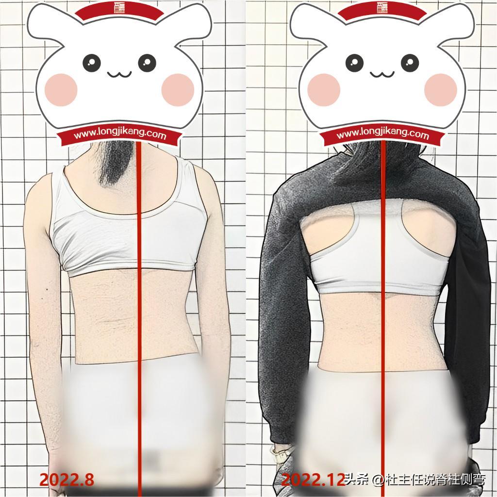 S型脊柱侧弯，一定要戴长支具矫形吗？此文告知您