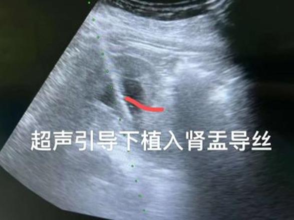 直肠癌转移的方式,直肠癌转移盆腔化疗方案