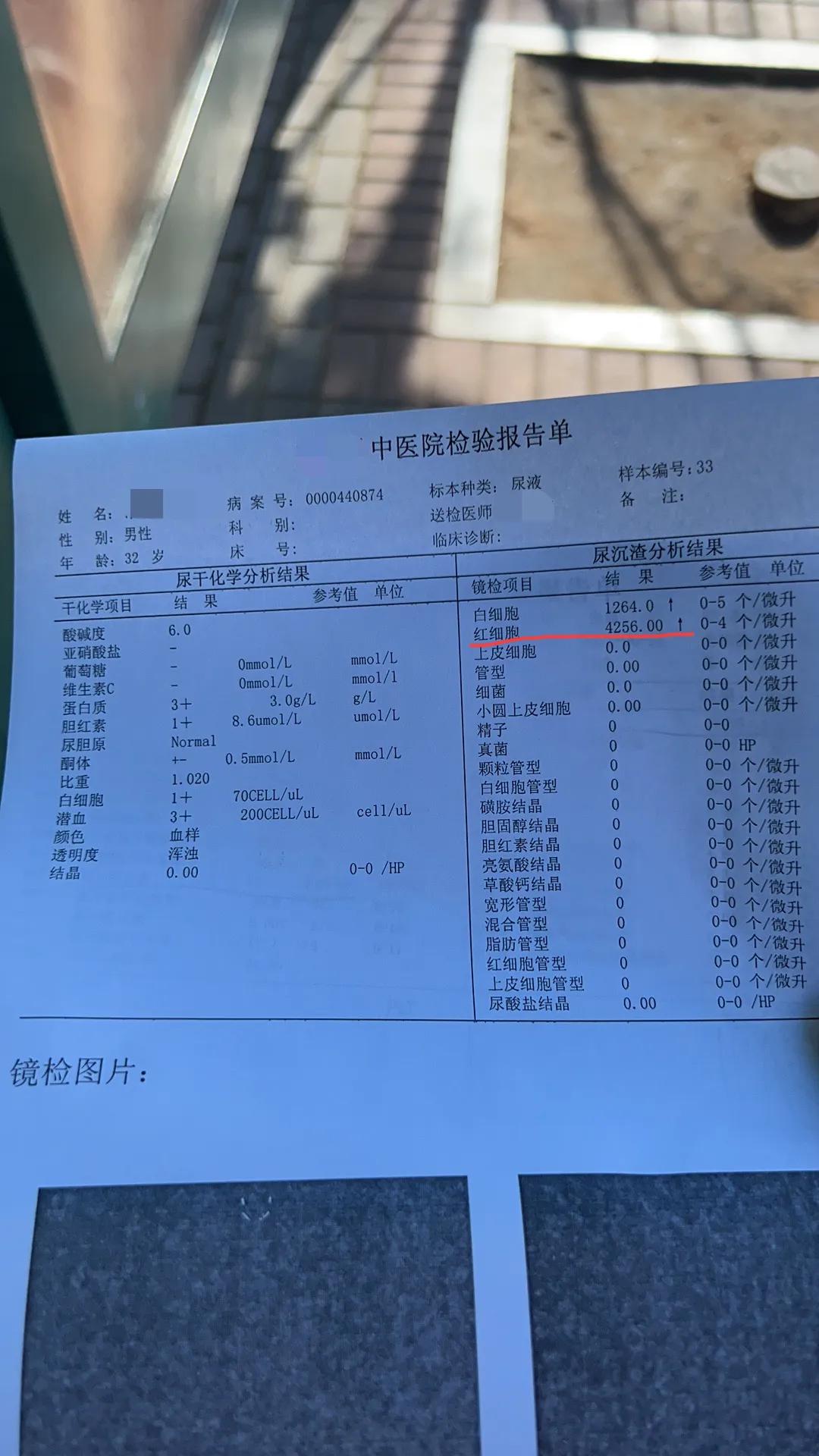 急性白血病的确诊依据,白血病m3的确诊方法