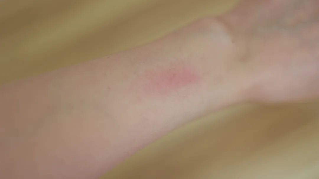 过敏性紫癜中医与西医哪个方法好,治疗过敏性紫癜该如何选择中医