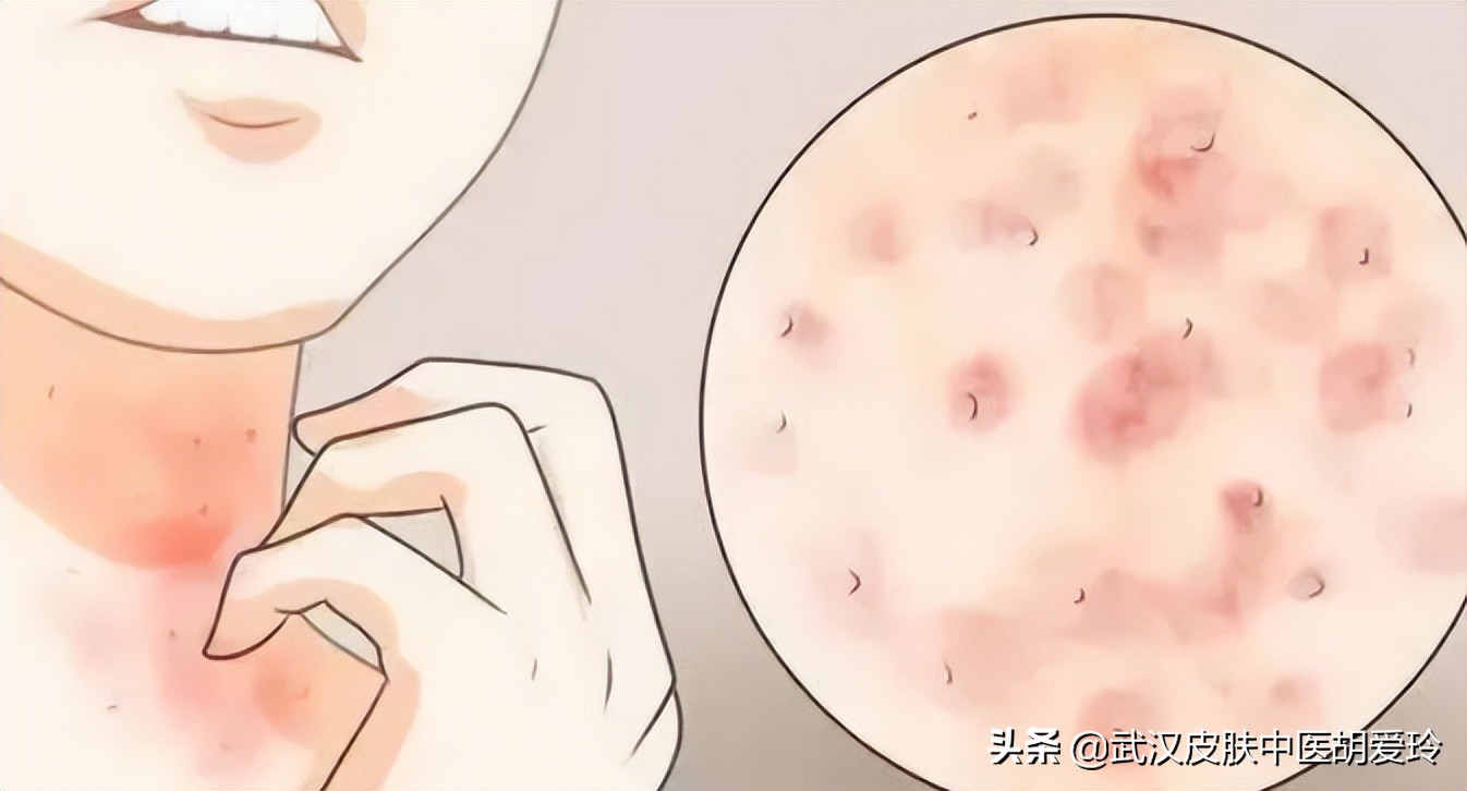 浑身痒怎么办特别是在晚上,晚上身上起疙瘩很痒像蚊子叮的包