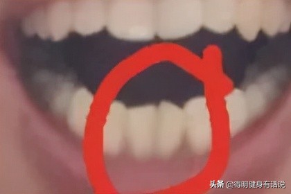 牙齿快暴露牙本质了怎么修复,牙齿已经露出牙本质了怎么修复