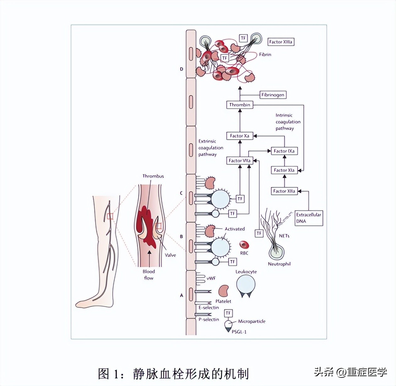 静脉血栓栓塞症相关题库,静脉血栓栓塞症英文