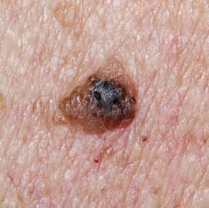 如何区别黑痣和黑色素瘤,怎样区别黑痣和黑色素瘤