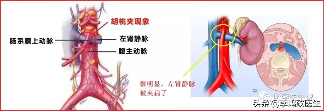 女子腰椎突出腰痛,女子腰椎间盘突出