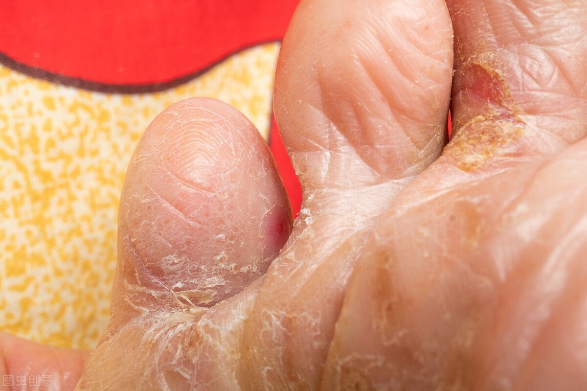 脚掌心水泡型足癣特别痒怎么办,脚趾发痒脱皮中医怎么诊断