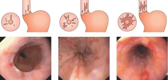 焦虑反酸烧心一定是胃食管反流吗,反酸烧心胃食管反流能自愈吗