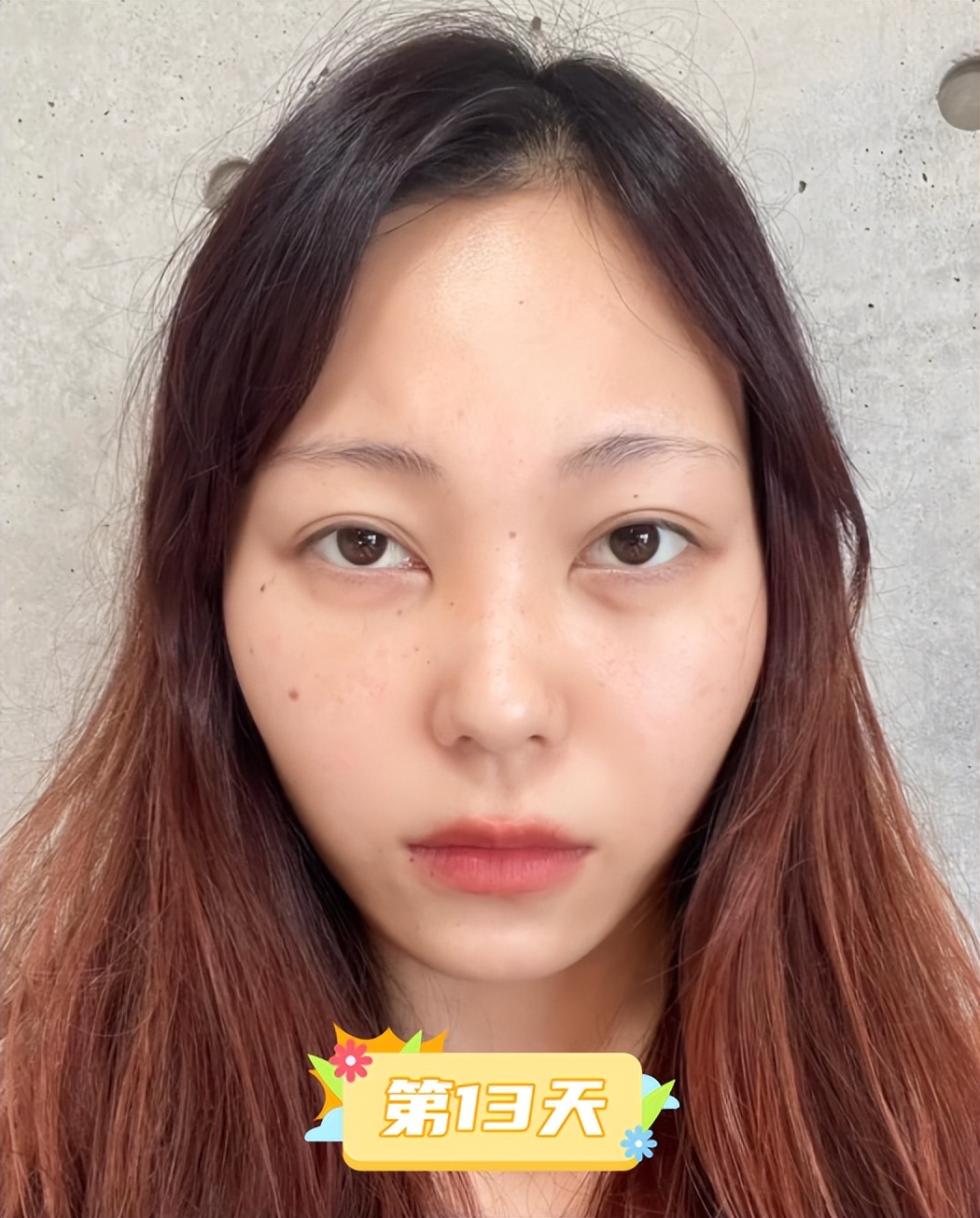 内切去眼袋手术全过程,做了去眼袋手术五天怎么还有眼袋