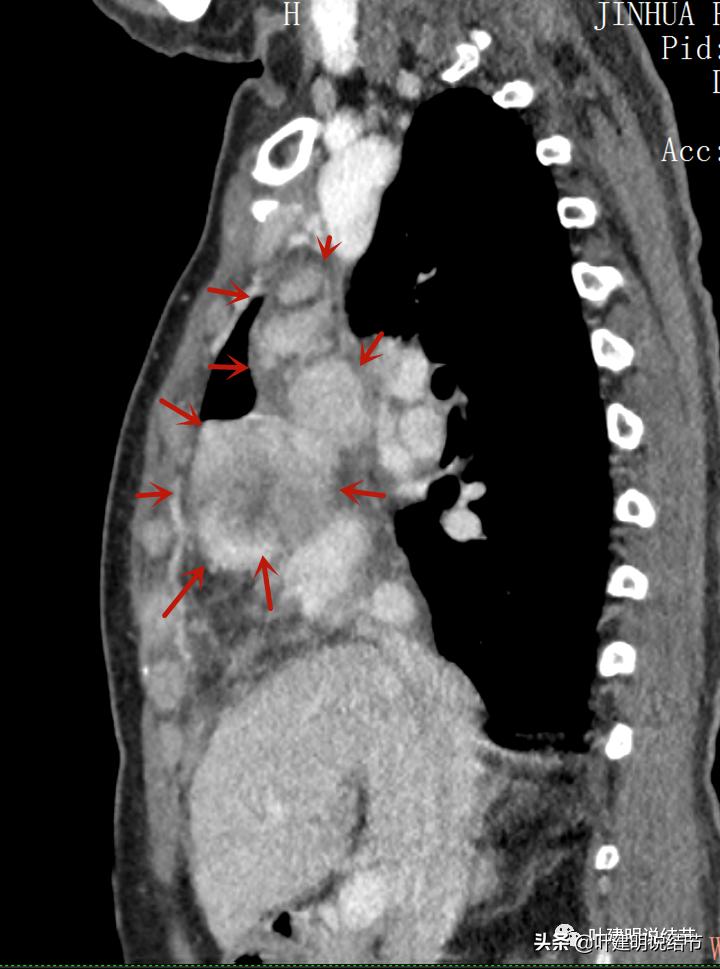 这位老乡，乏力来查，查出这么大个的纵隔肿瘤！会是什么呢？