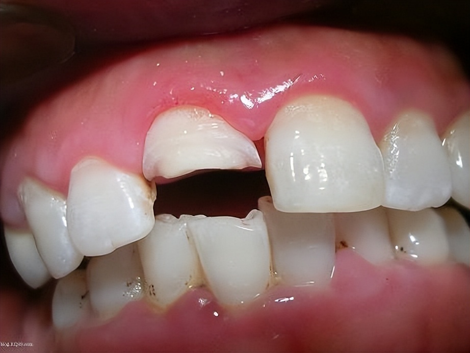 牙齿断了一半怎么处理最好多少钱,牙齿断了一半怕冰怎么处理最好