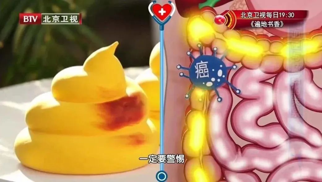 便血怎么判断是痔疮还是肠癌颜色,专家教您如何辨别痔疮便血与肠癌