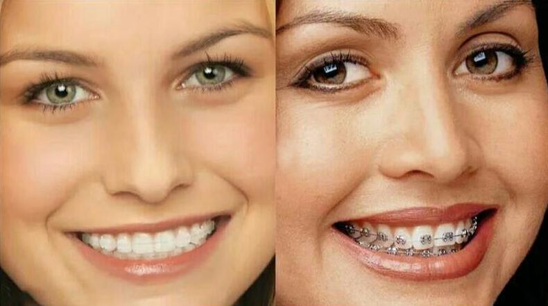 隐形牙套暴利,隐形牙套销售好做吗