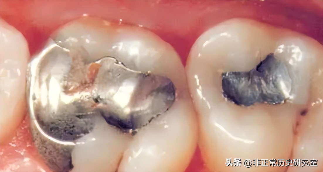 水银与碘化钾治疗梅毒,中世纪水银治疗梅毒