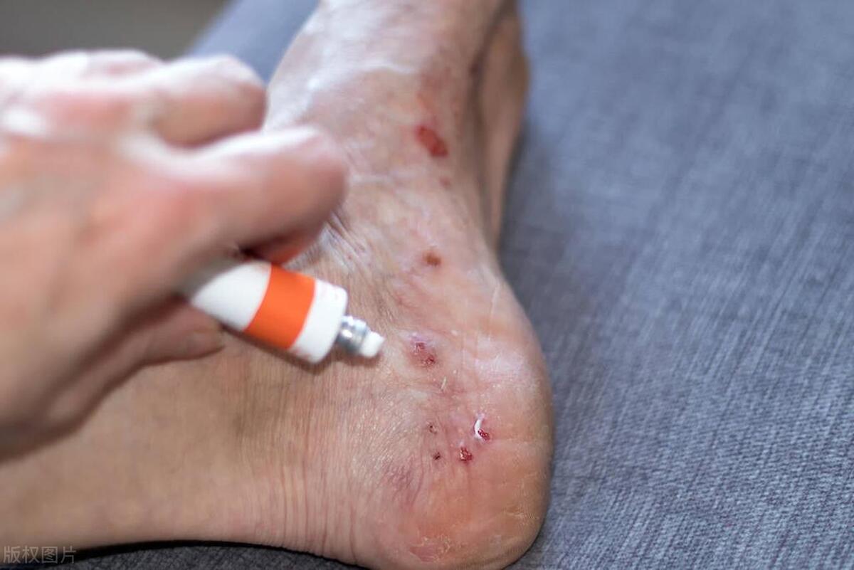 湿疹皮肤溃烂抹什么中药药膏,湿疹用的中药外用药