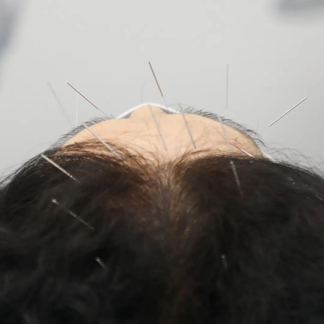 看这里！中医教你如何改善视神经萎缩