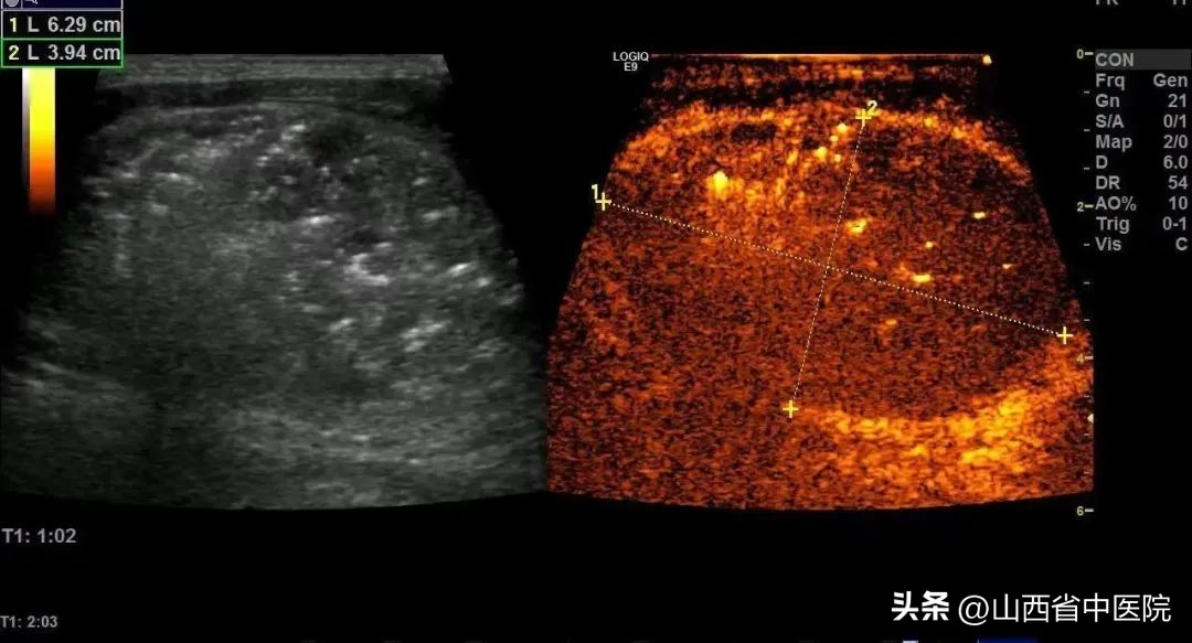 山西省肿瘤医院甲状腺结节消融,江苏省人民医院甲状腺结节消融术