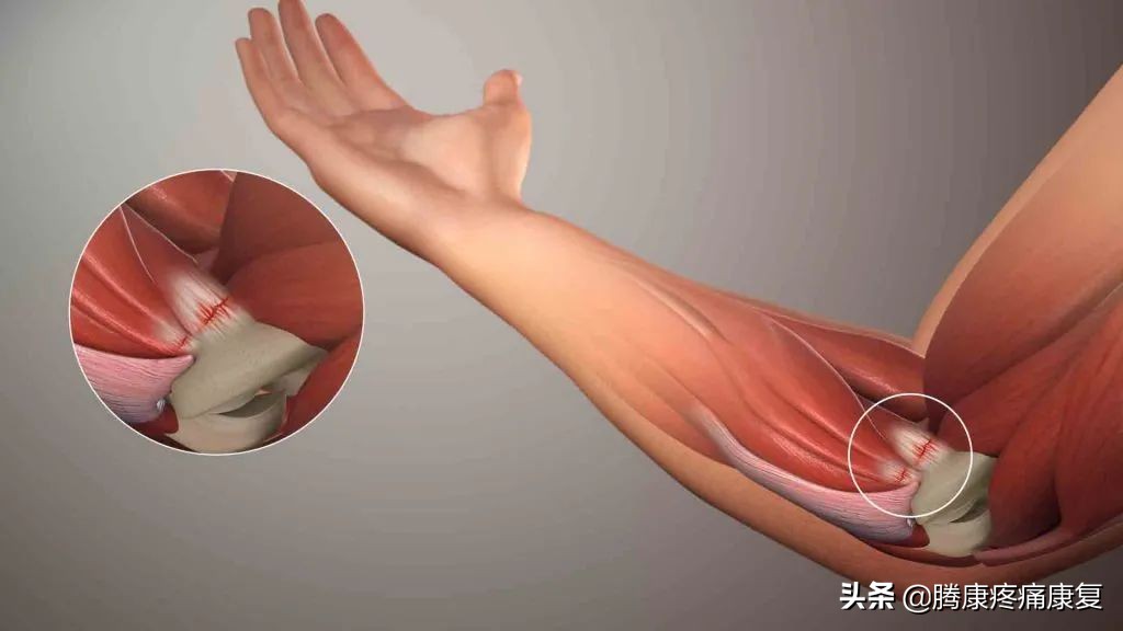 前臂桡侧疼痛怎么缓解,前臂疼痛按摩如何缓解