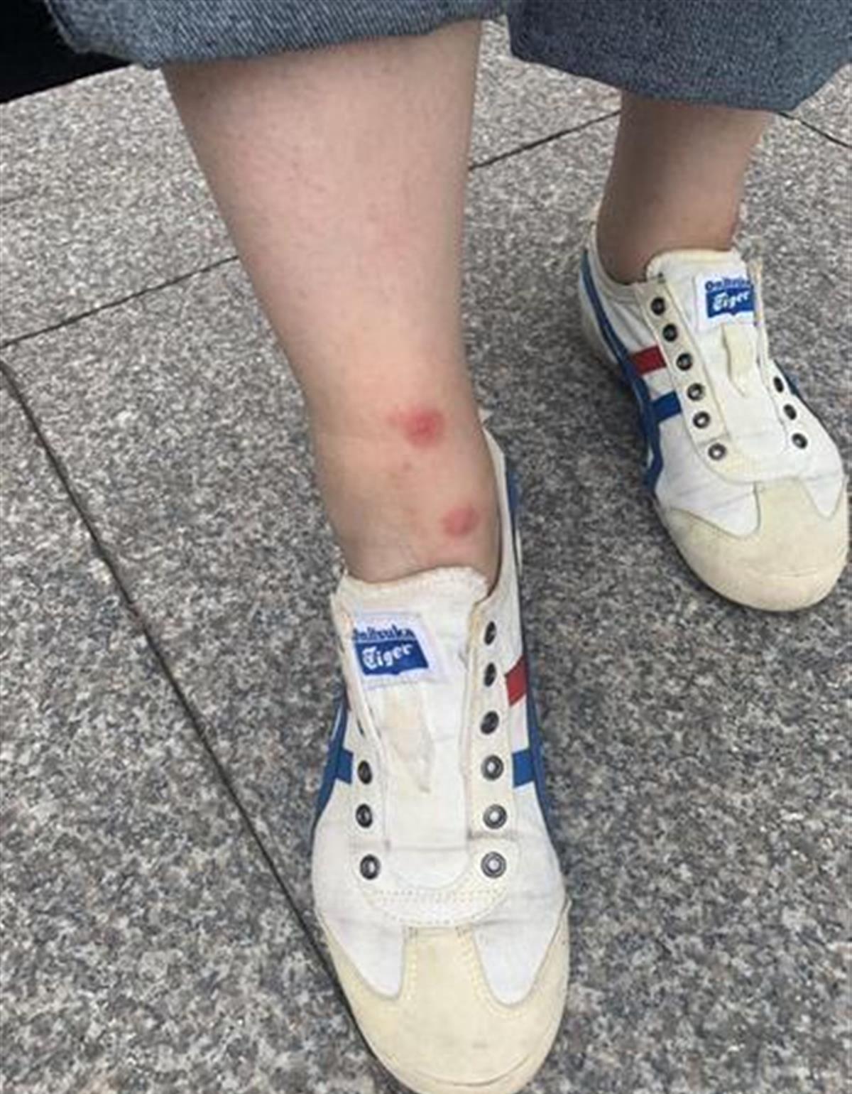 女生被蚊虫叮咬涂抹什么,不明蚊虫叮咬后开始红肿晚上瘙痒