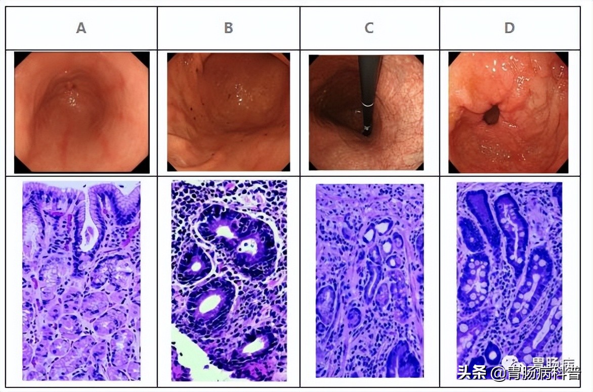 萎缩性胃炎伴肠化异型增生怎么办,萎缩性胃炎肠化及增生能逆转吗
